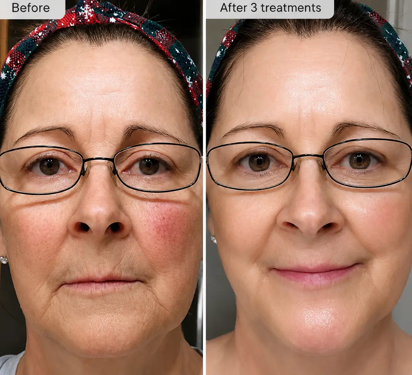 Refresh the look of dull skin with the Micro-Infusion Facial System