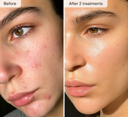 Refresh the look of dull skin with the Micro-Infusion Facial System